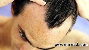 nearly half of men experience some degree of baldness by the age of 50